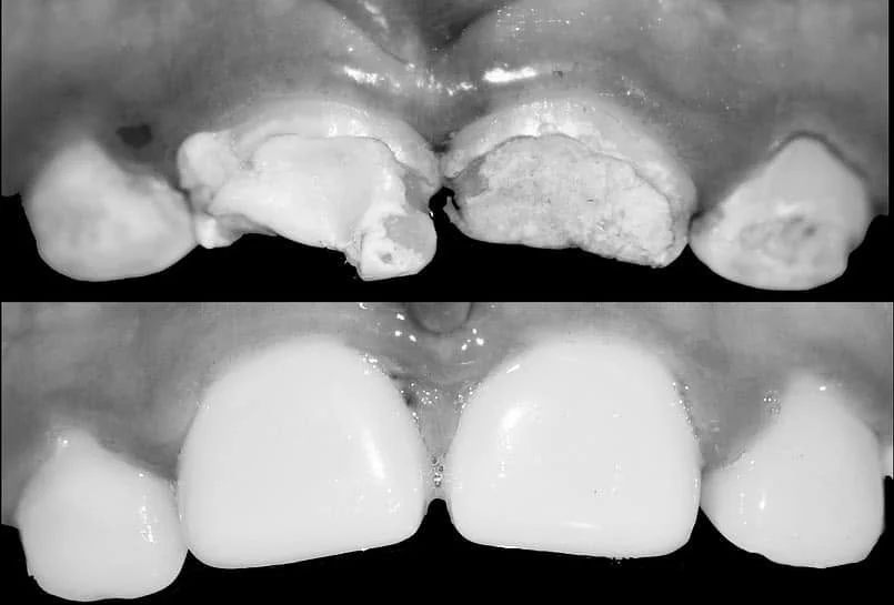 Comparativa de antes y después de un caso dental frontal