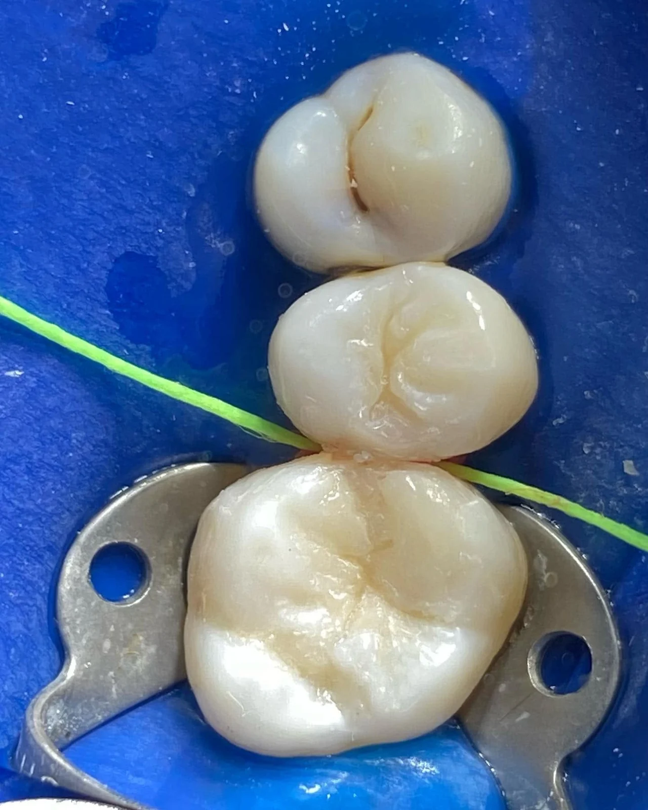 Resultado de una restauración dental